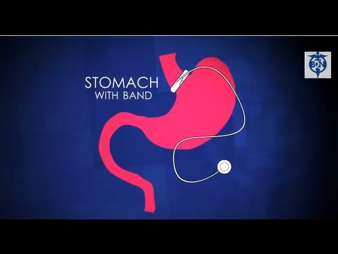 Lap-Band Surgery with Weight Loss Surgon Dr. Philip Swanson