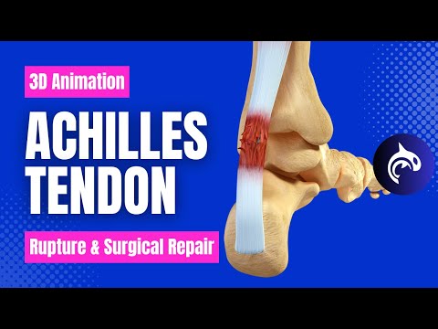 Achilles Tendon Rupture and Repair - 3D Animation