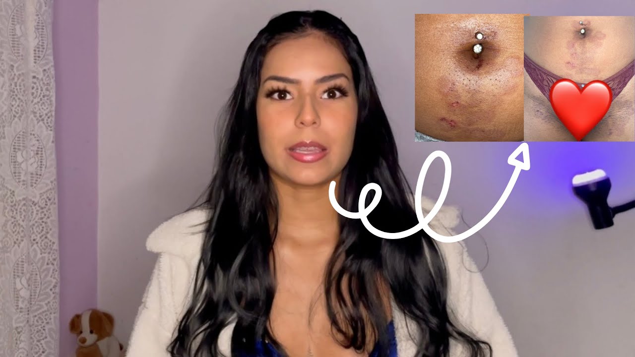 ME QUEIMARAM NA ESPAÇO LASER - O QUE USEI PRA CLAREAR AS MANCHAS