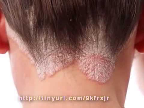 El tratamiento de la psoriasis por la póliza La eccema el tratamiento ozonoterapiya