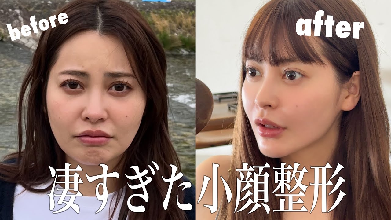 凄すぎた小顔整形レポ！ほうれい線もなくなった😭