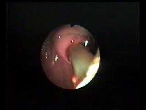 Worm Removal From The Biliary Tracts
