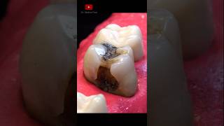 Download lagu Root Canal Treatment and restoration #satisfying mp3 Download lagu Root Canal Treatment and restoration #satisfying mp3
