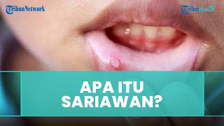 Apa yang Dimaksud dengan Sariawan? Ini Penjelasan dari Dokter