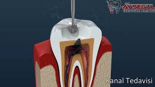 Kanal Tedavisi Nasıl Yapılır?  Endodonti