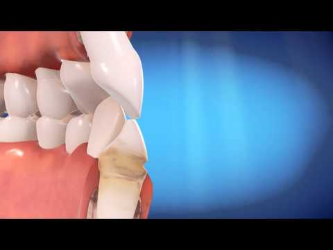 Straight Talk About Invisalign