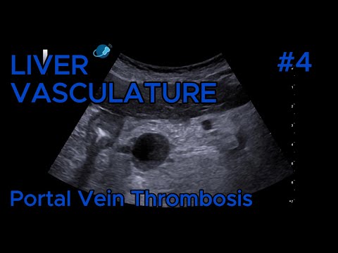Portal vein thrombosis video preview