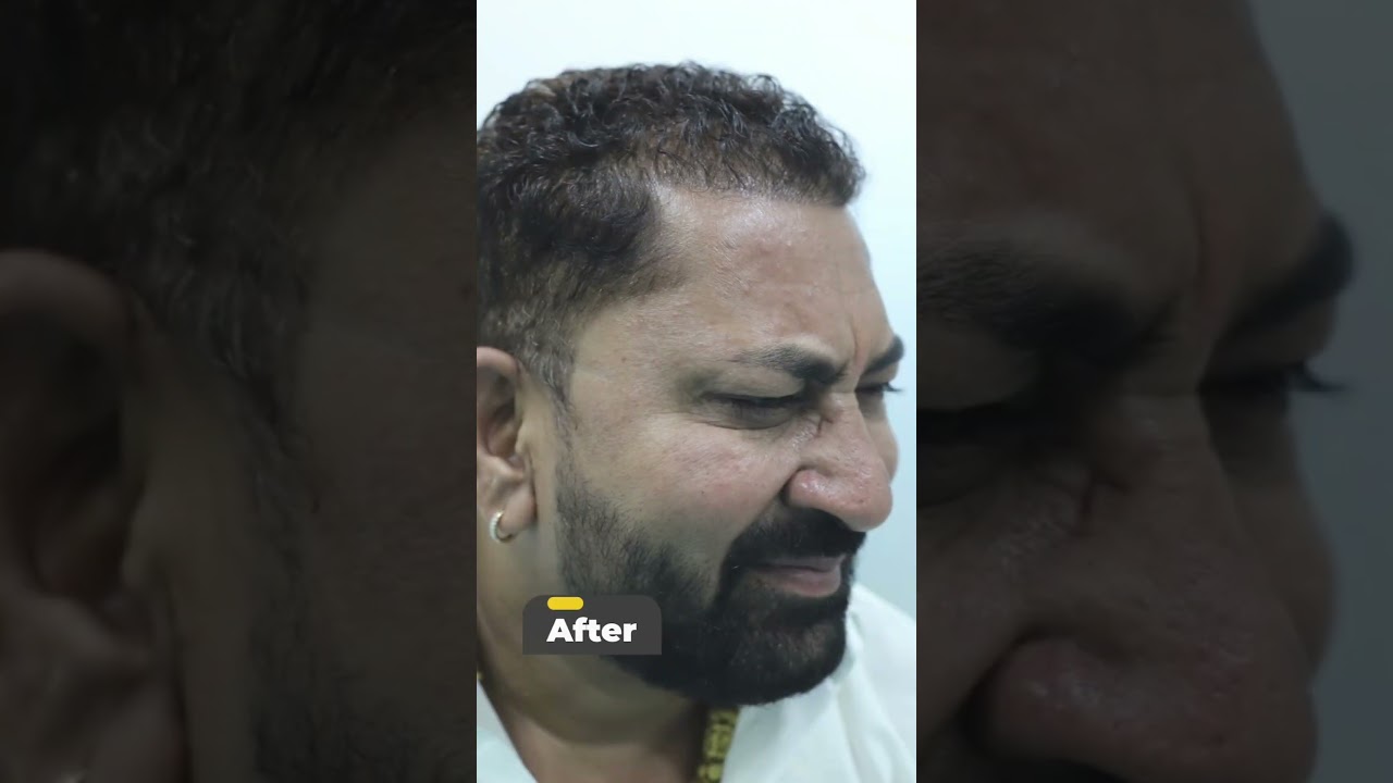 Botox skin treatment  #skincare #laserskinrejuvenation #beauty #laserskinresurfacing #beforeandafter