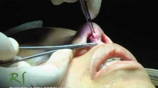 OR Video Footage: Closing the Incisions After NoseJob