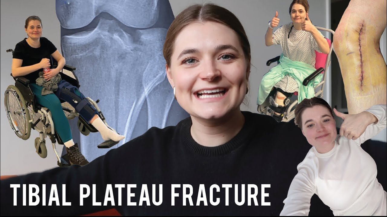 Surgical Tibial Plateau Fracture ORIF Recovery - 0-6 weeks post op with photos