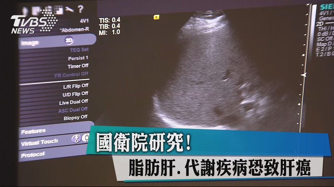 國衛院研究! 脂肪肝、代謝疾病恐致肝癌