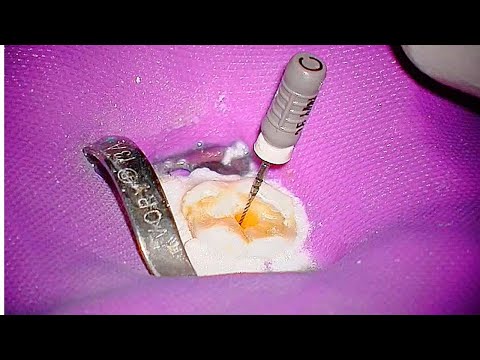 Root Canal Glide Path Help - 6,8,10 sequence - The Calcified Tooth Series Part 2