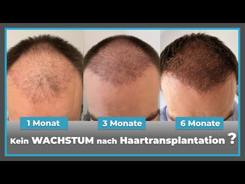 3-6 months after hair transplantation: When does GROWTH finally begin?