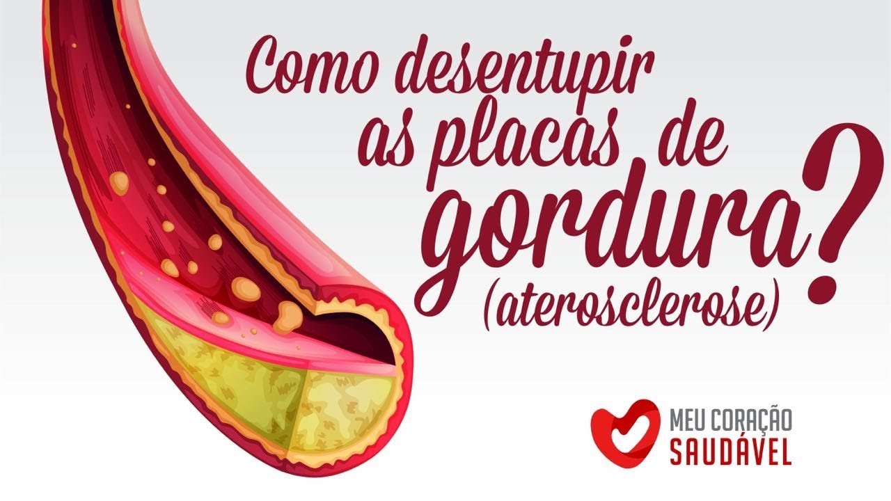 Como desentupir as "placas de gordura" (aterosclerose) que se acumulam no corpo?