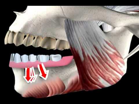 What is a hybrid prosthesis