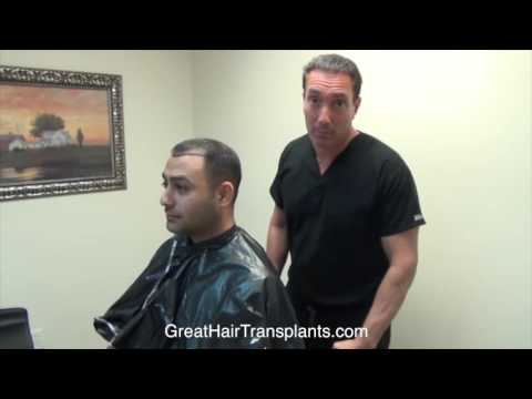 Dr. Bolton Patient Amir MaxHarvest &trade; Hair Transplant Plus 
