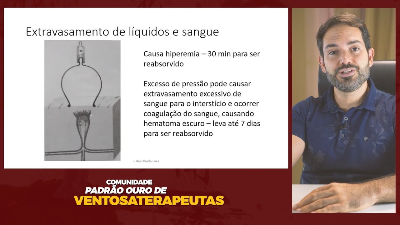 [Ventosa] Mini Curso de Ventosaterapia Grátis - O Padrão Ouro da Ventosaterapia