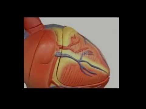 Herzinfarkt(Myokardinfarkt) leicht erklärt