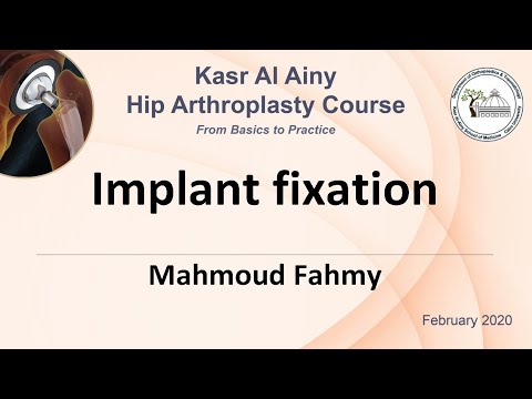 1-5 Implant fixation - Mahmoud Fahmy