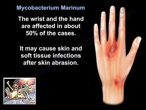 Mycobacterium Marinum - Everything You Need To Know - Dr. Nabil Ebraheim - YouTube