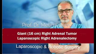 Miniaturka - Laparoscopic Adrenalectomy. Giant Tumor (16cm). Metin Ertem MD.FACS