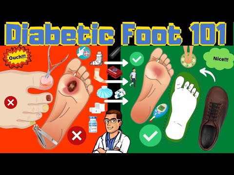 Heel Spurs Plantar Fasciitis BEST Home Treatment 2022