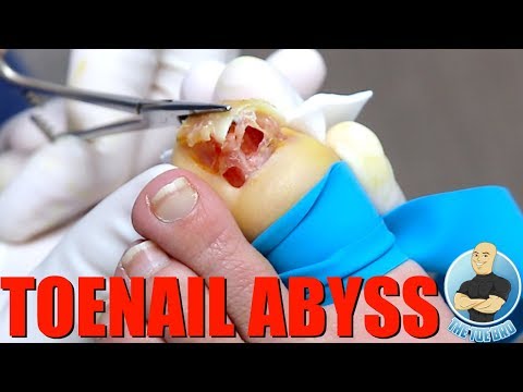 RELEASING A POCKET OF INFECTION IN A TOENAIL