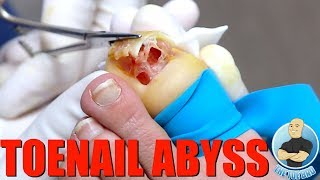 RELEASING A POCKET OF INFECTION IN A TOENAIL