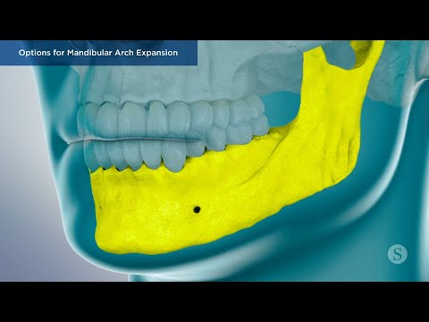 Options for Mandibular Arch Expansion