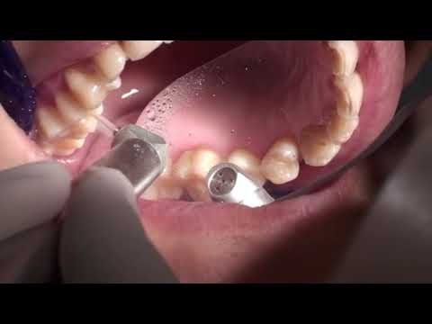 Periodontal Debridement with LIGHTMED's SAPPHIRE Laser