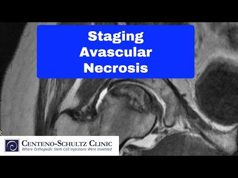 AVN avascular necrosis stages