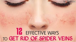 12 Effective Ways To Get Rid Of Spider Veins | Healthspectra