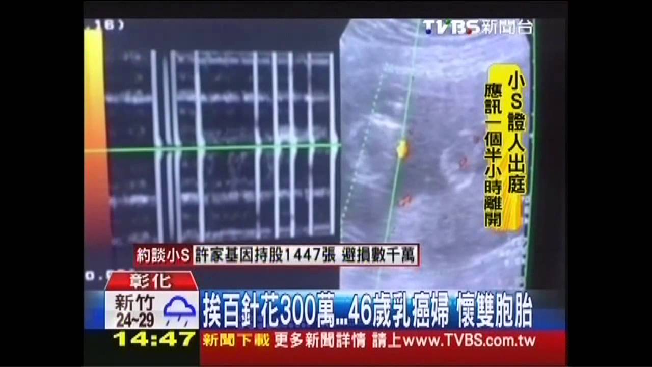 挨百針花300萬 46歲乳癌婦懷雙胞胎