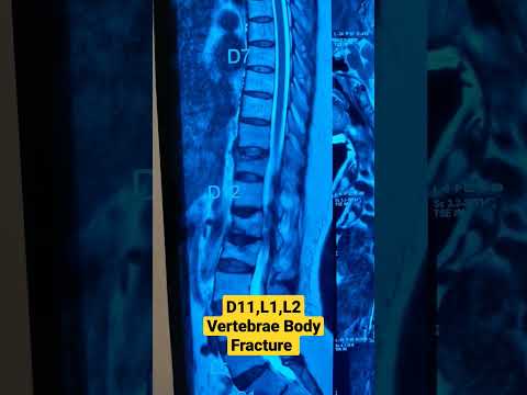 D11,L1,L2 Vertebrae Body Fracture ..Dr Sai Chandra MBBS DNB Ortho