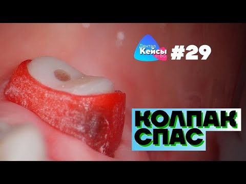 Колпак спас | Дентал Кейсы от BG #29