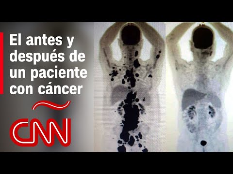 Antes y después de un paciente con cáncer que tuvo remisión en 1 mes gracias a terapia de células