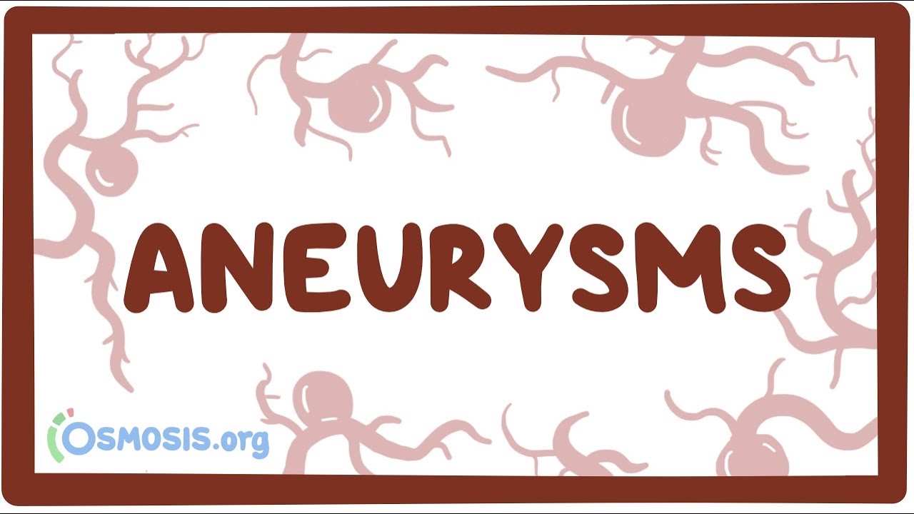 Aneurysms - causes, symptoms, diagnosis, treatment, pathology