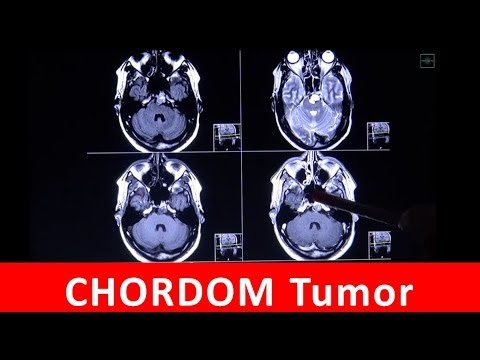 Hypertension Schritt 3 Grad 4 Hypertonie keinen Punkt