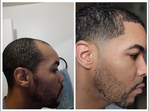 First Haircut After Hair Transplant- 6 Month Update