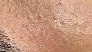 Deep & Relaxing Acne Removal with Linh Mydang #575 P1