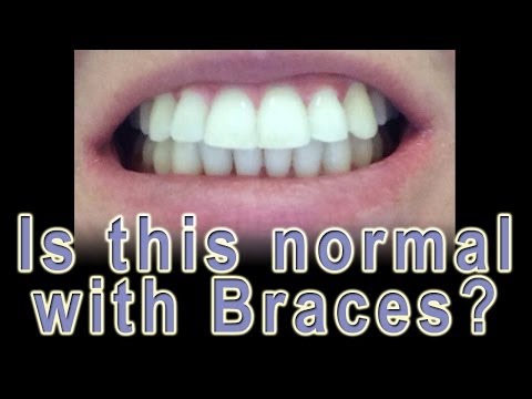 download lagu mp3 mp4 Buck Teeth After Braces, download lagu Buck Teeth After Braces gratis, unduh video klip Buck Teeth After Braces