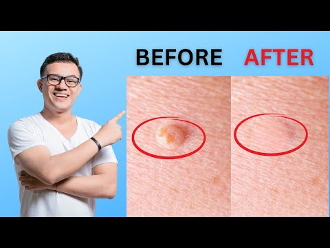 How To Remove Skin Tags And Warts Overnight