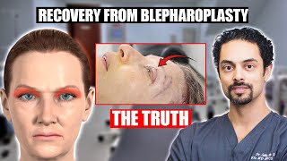 What is the recovery after blepharoplasty/ eyelid surgery? The truth revealed...
