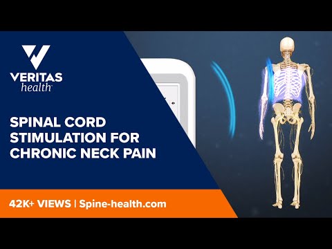 Spinal Cord Stimulation for Chronic Neck Pain