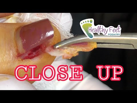 Kuko halamang-singaw paggamot sa Essentuki Ciclopirox kuko halamang-singaw