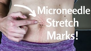 Microneedling STRETCH MARKS! | Microneedle Stomach