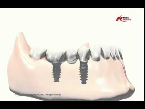 Brücke auf Implantaten