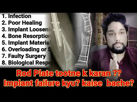 Common reasons for broken rod plate and how to avoid them | Implants Failure Causes**