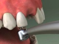 Dentist Maryland Bridge Procedure