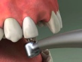 Dentist - Maryland Bridge Procedure 